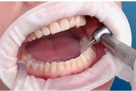 OPTRAGATE SMALL МАЛЫЕ, 1ШТ., IVOCLAR 0001910870